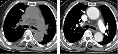 CT characteristics and clinical implications of acute type A aortic intramural hematoma